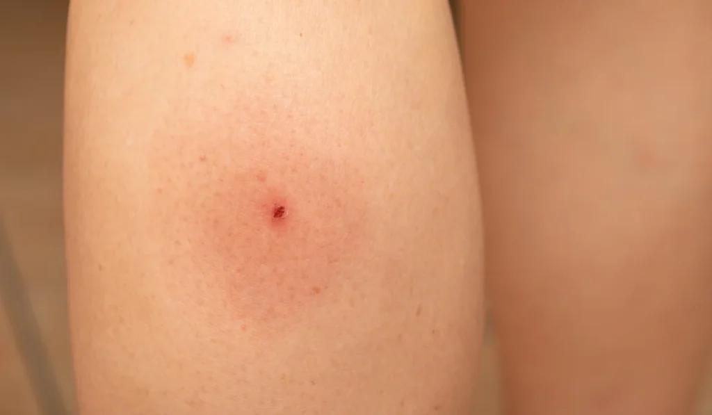 Close-up of an inflamed tick bite showing redness and a small wound, highlighting the skin irritation caused by the insect
